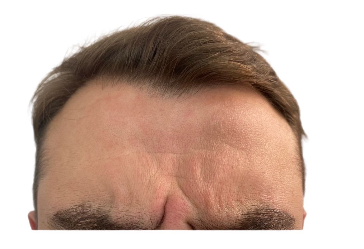 A close up of a man 's forehead with a beard.