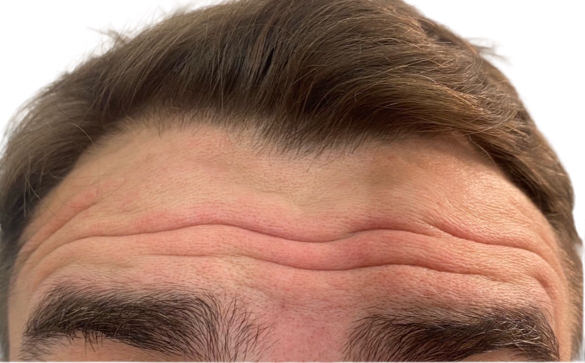 A close up of a man 's forehead with wrinkles and eyebrows.