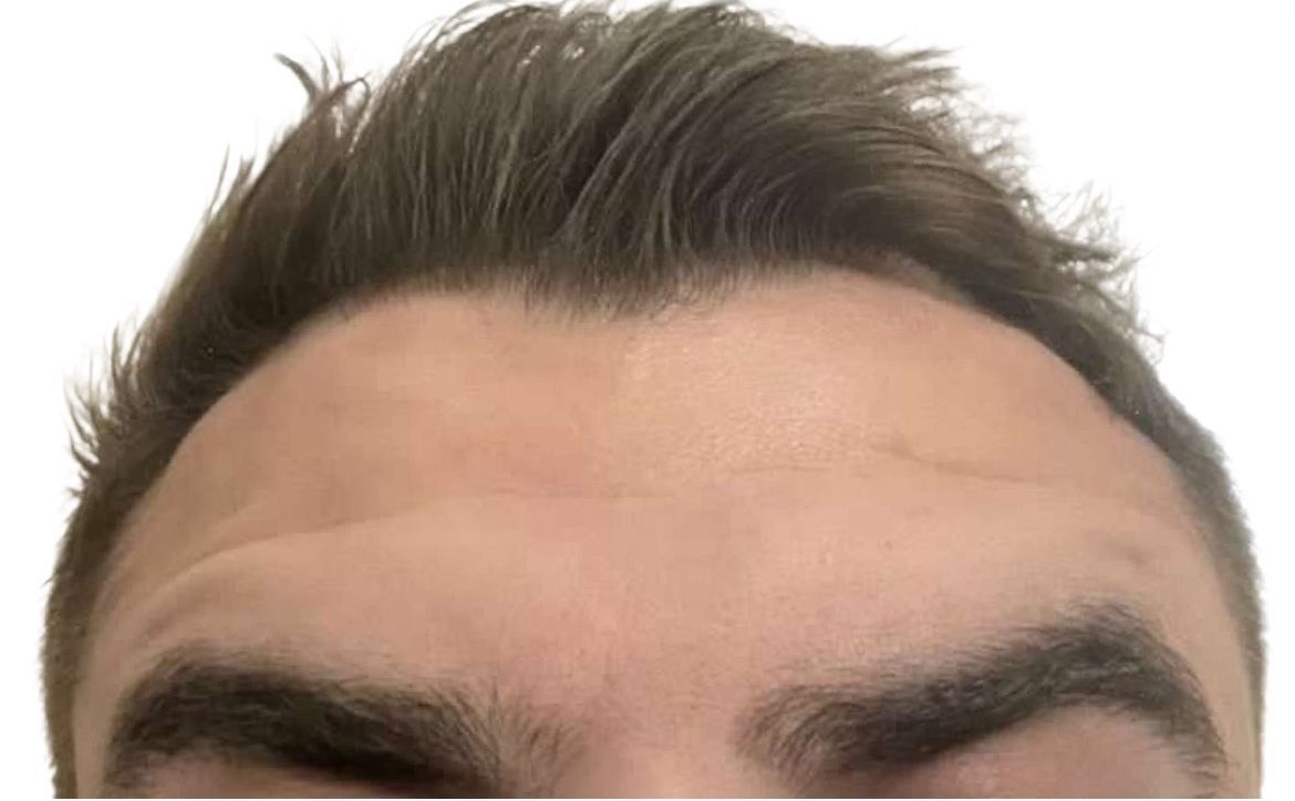 A close up of a man 's forehead and eyebrows.