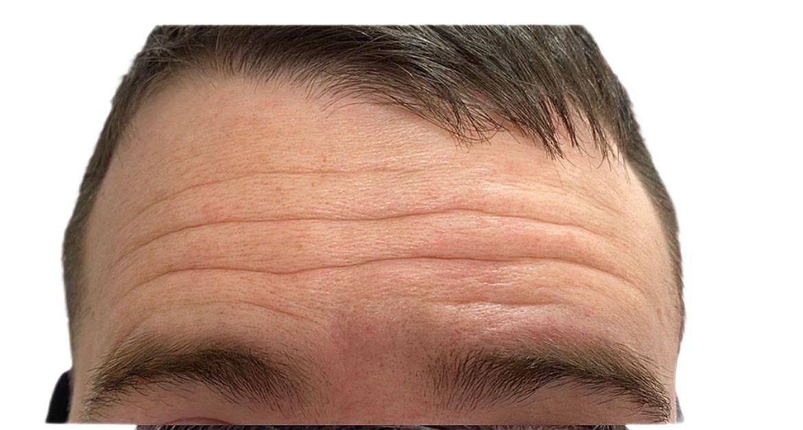 A close up of a man 's forehead with wrinkles and a beard.