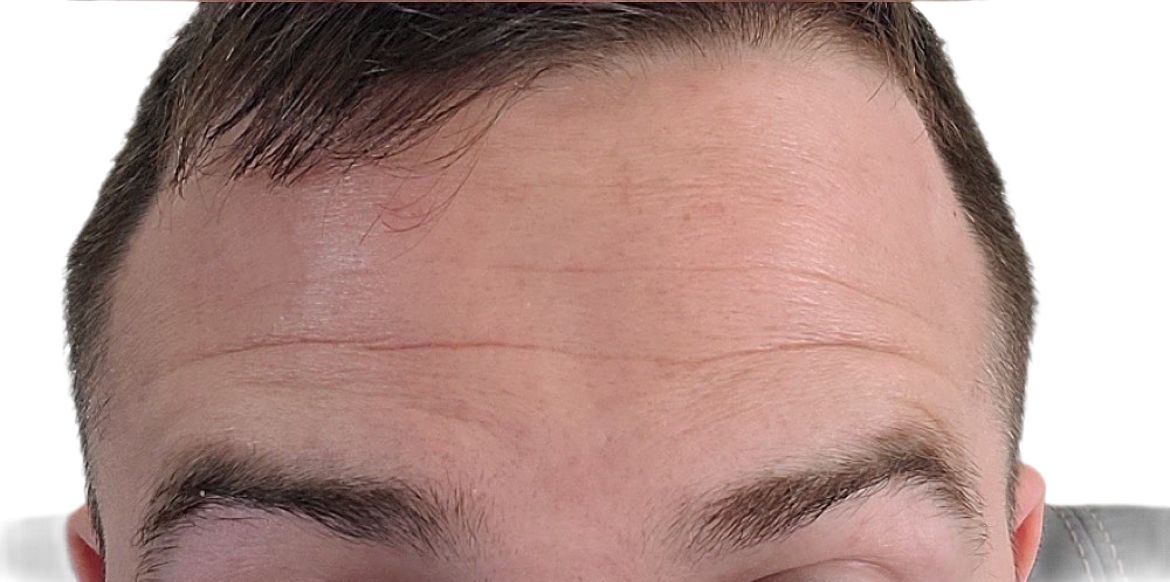 A close up of a man 's forehead and eyebrows on a white background.