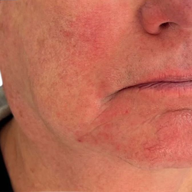 A close up of a man 's face with red spots on it.