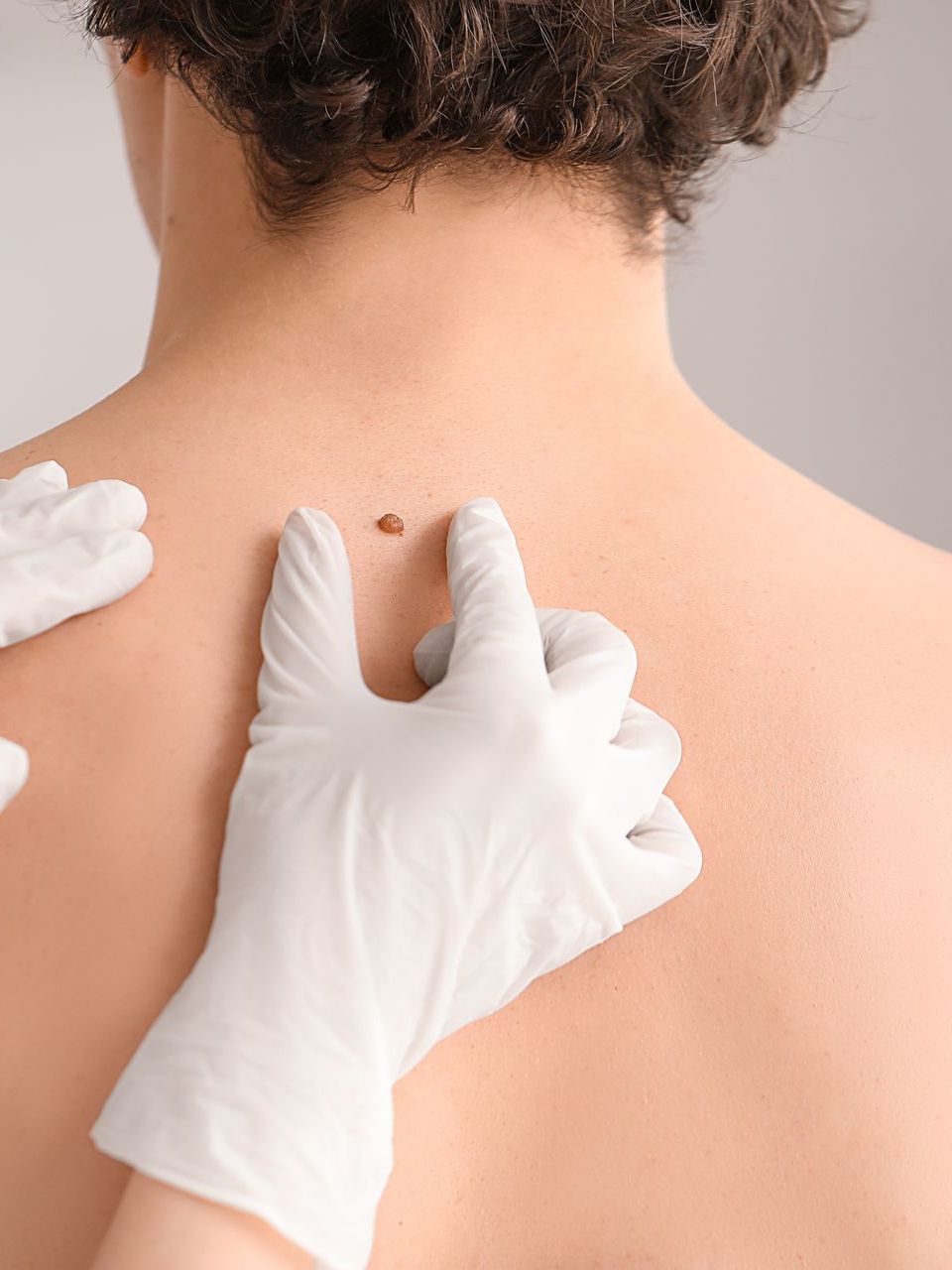 A doctor is examining a man 's back for a mole.