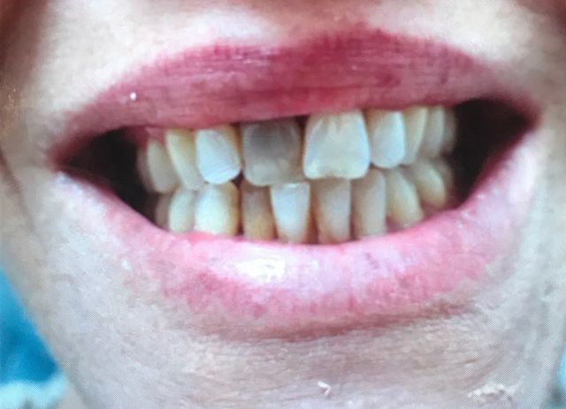 discolored+tooth+before+ 640w