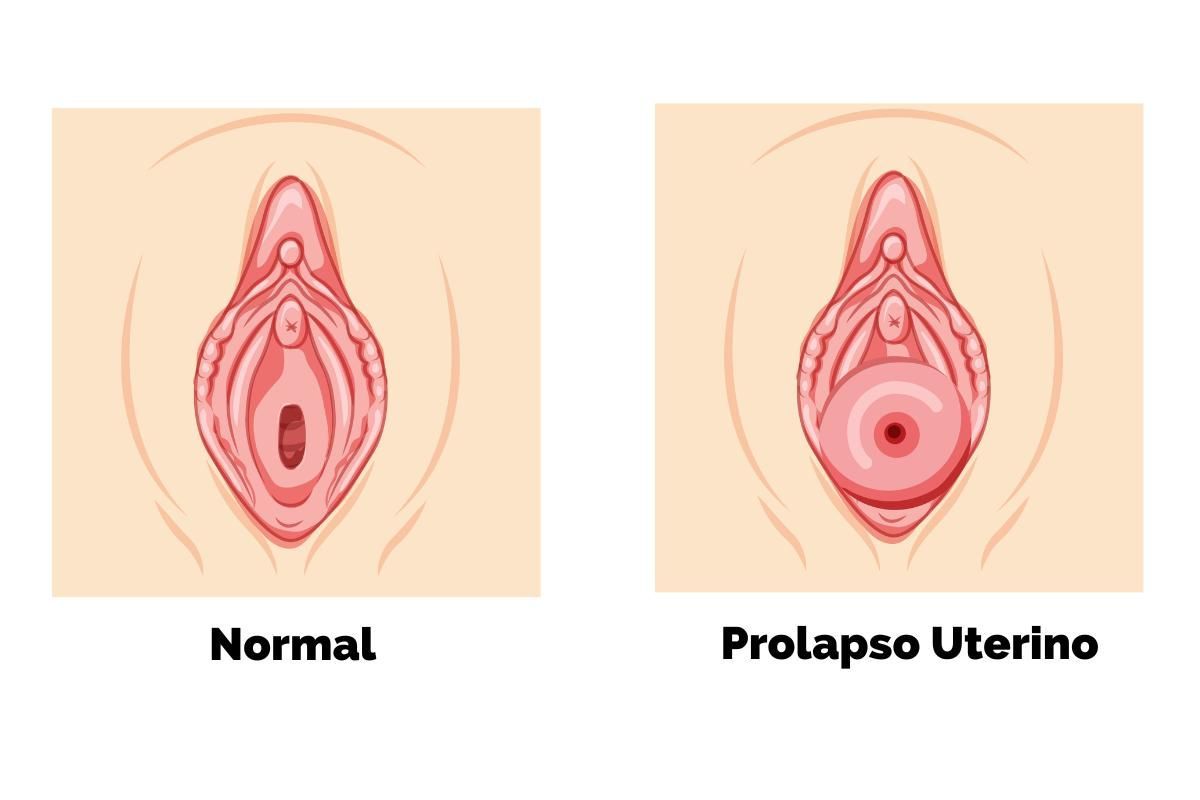 prolapso uterino