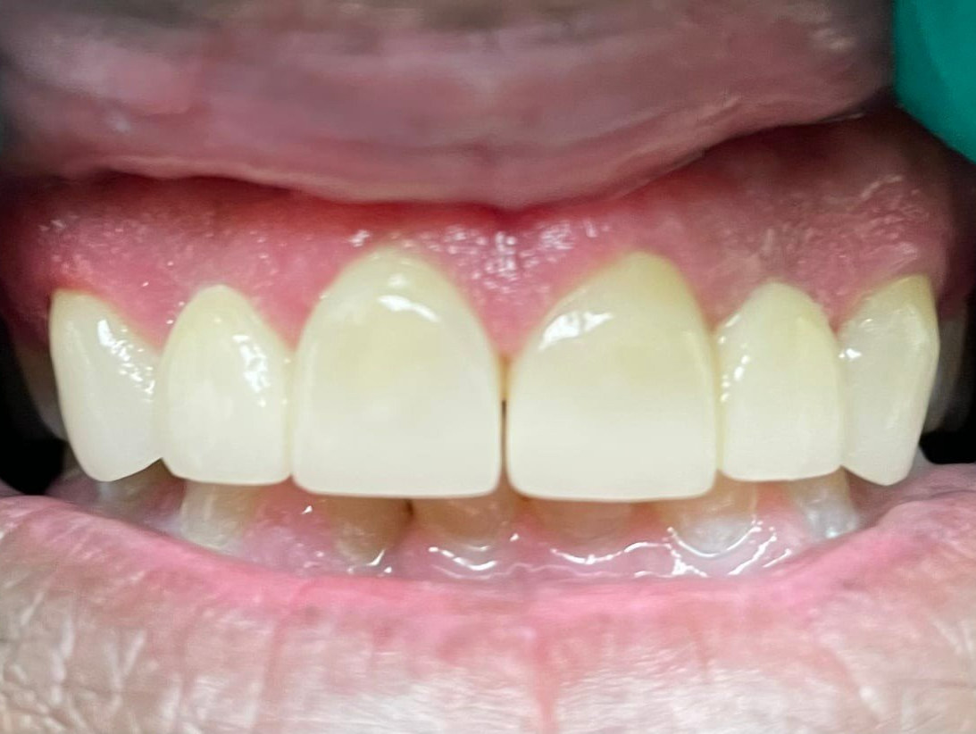 Patient A Veneers After — Wyoming, MI — Dental South