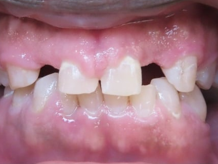 Patient A Veneers Before — Wyoming, MI — Dental South