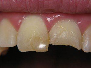 Patient C composite bond before  — Wyoming, MI — Dental South