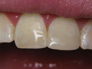 Patient C composite bond after — Wyoming, MI — Dental South