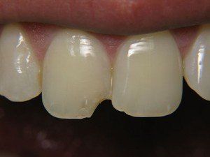 Patient D composite bond before — Wyoming, MI — Dental South