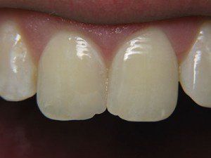 Patient D composite bond after — Wyoming, MI — Dental South