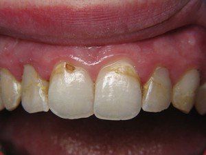 Patient E composite bond before — Wyoming, MI — Dental South