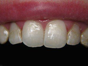 Patient E composite bond after — Wyoming, MI — Dental South