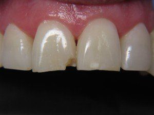 Patient F composite bond before — Wyoming, MI — Dental South