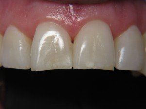 Patient F composite bond after — Wyoming, MI — Dental South