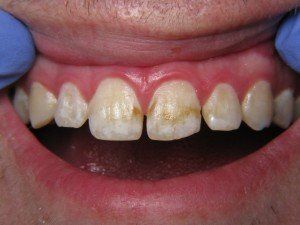 Patient B composite bond before — Wyoming, MI — Dental South