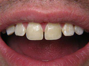 Patient B composite bond after — Wyoming, MI — Dental South