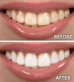 Before and after teeth whitening — Wyoming, MI — Dental South