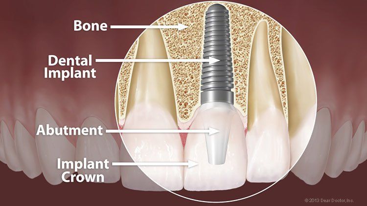 Dental Implant — Wyoming, MI — Dental South