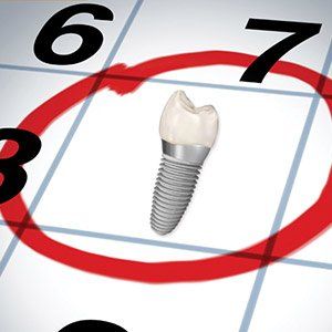 Tooth for implant — Wyoming, MI — Dental South