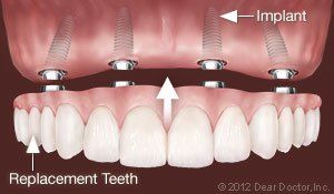 Replacing all teeth permanently — Wyoming, MI — Dental South