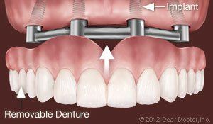 Support removable dentures — Wyoming, MI — Dental South