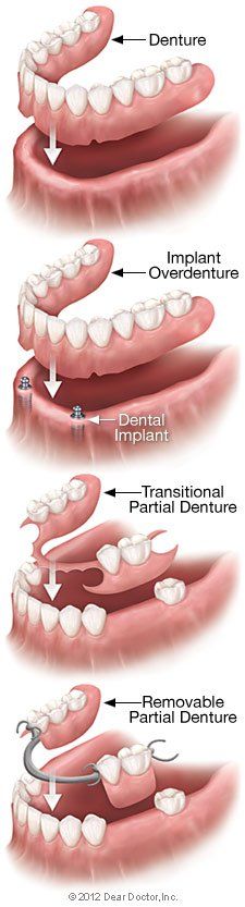 Type of full dentures — Wyoming, MI — Dental South