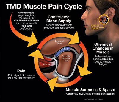 TMD pain cycle — Wyoming, MI — Dental South