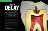 Tooth decay article — Wyoming, MI — Dental South
