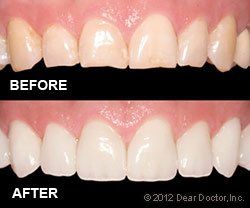 Before and after porcelain Veneers — Wyoming, MI — Dental South