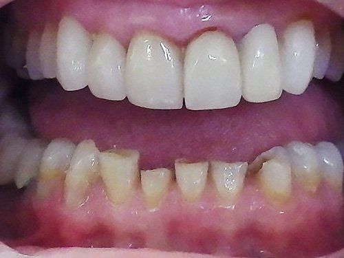 Dental Fillings Before