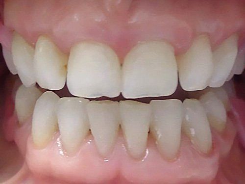 Dental Fillings Before