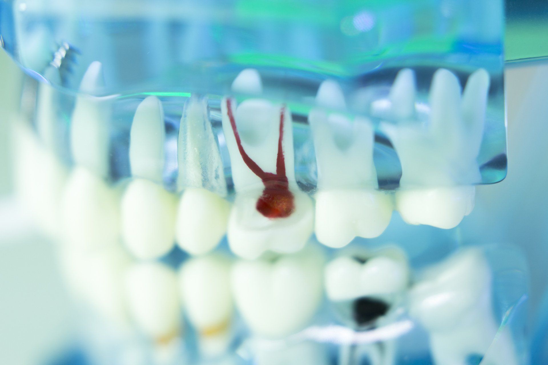 Root canal treatment, Wonderful Smiles