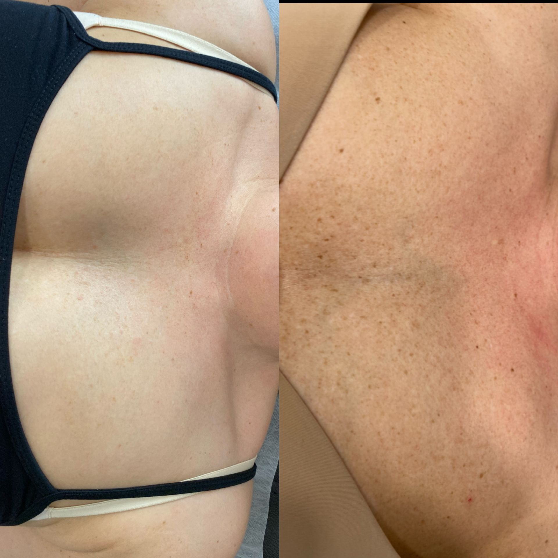 Lumecca IPL Before and After