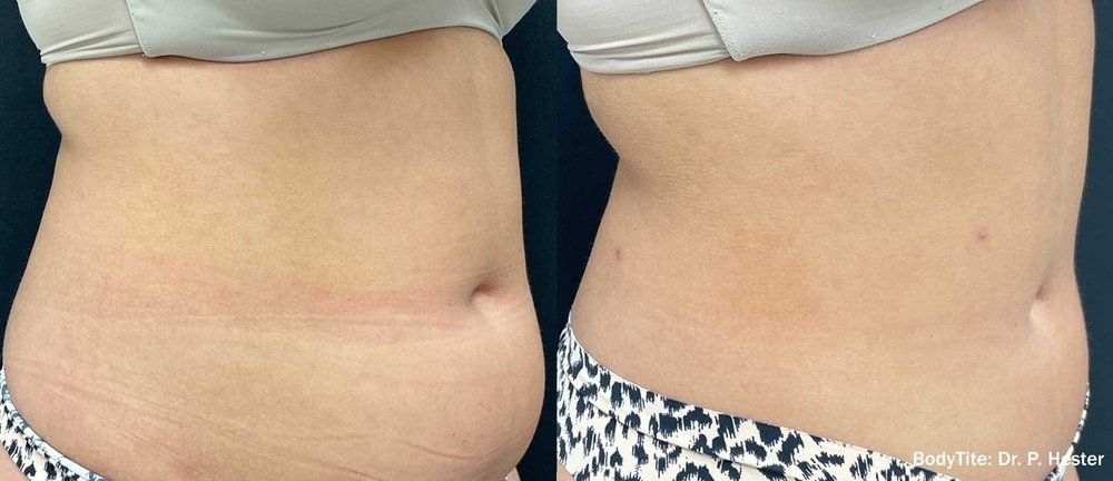 BodyTite before and after 5