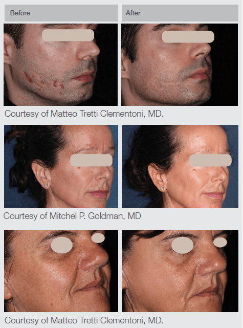 Laser Skin Treatments