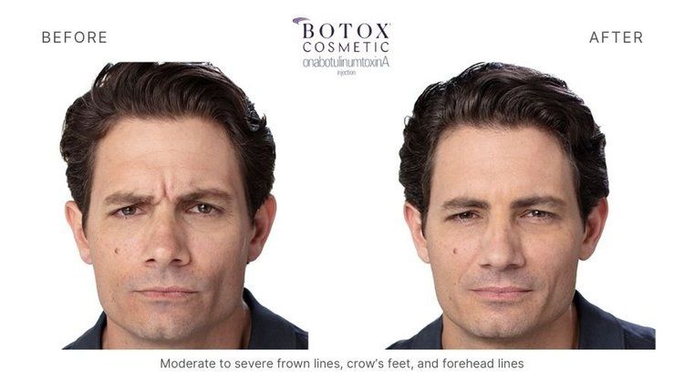 botox before and after  3
