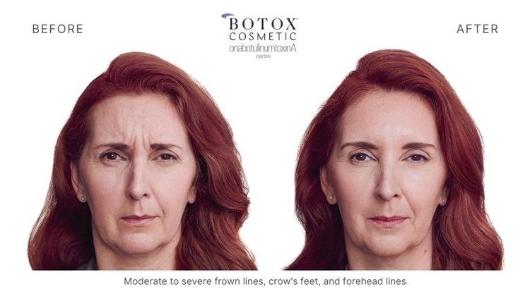botox before and after  9