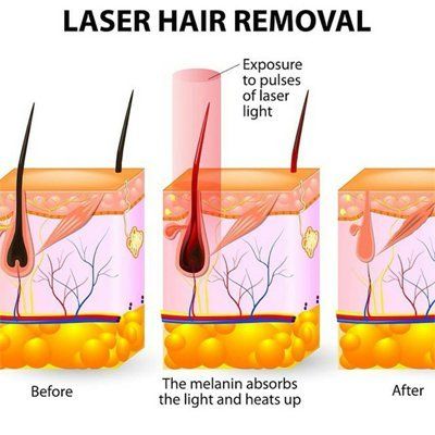 Laser hair removal specialist in Birmingham