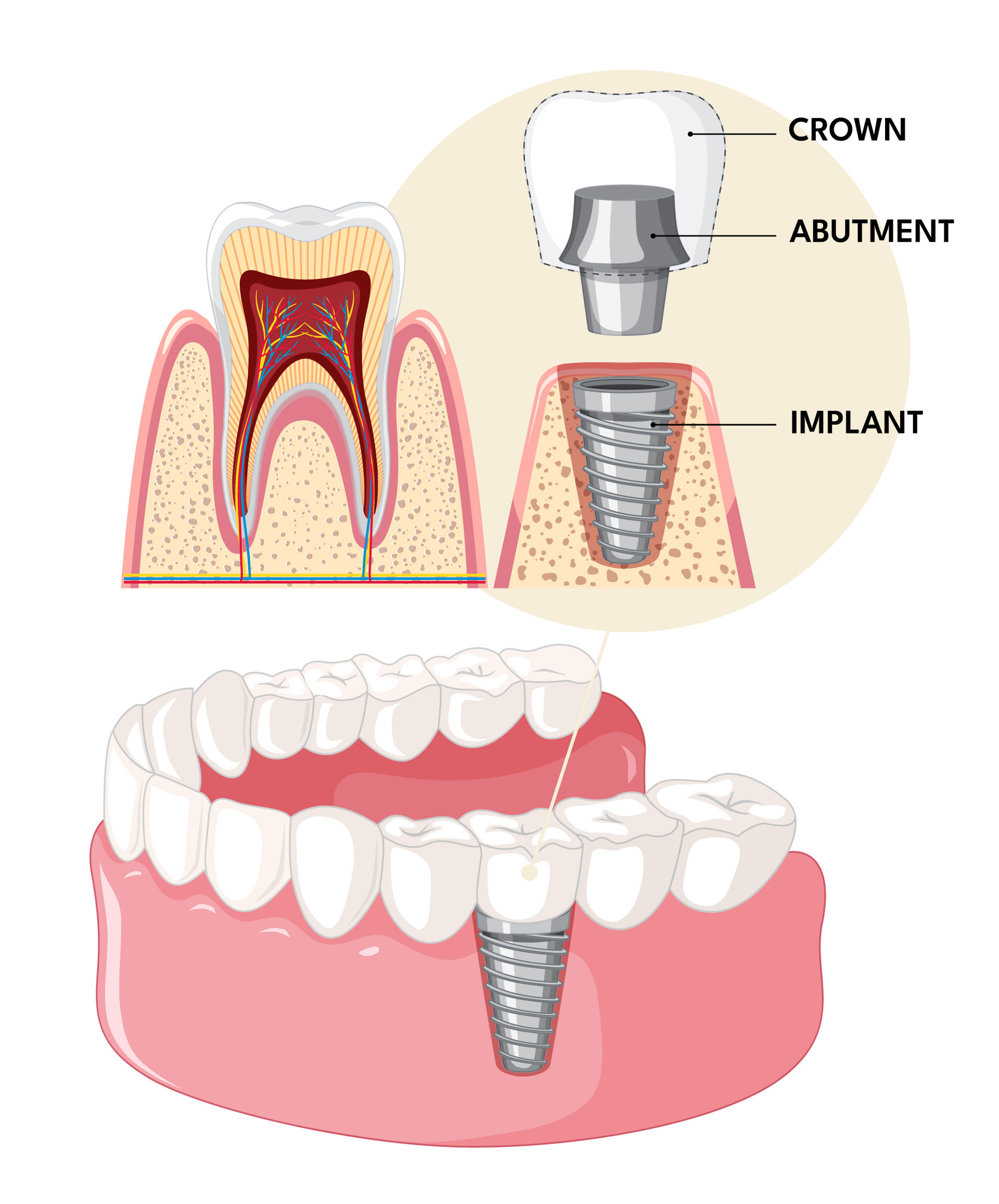 Implant Dentistry diagram