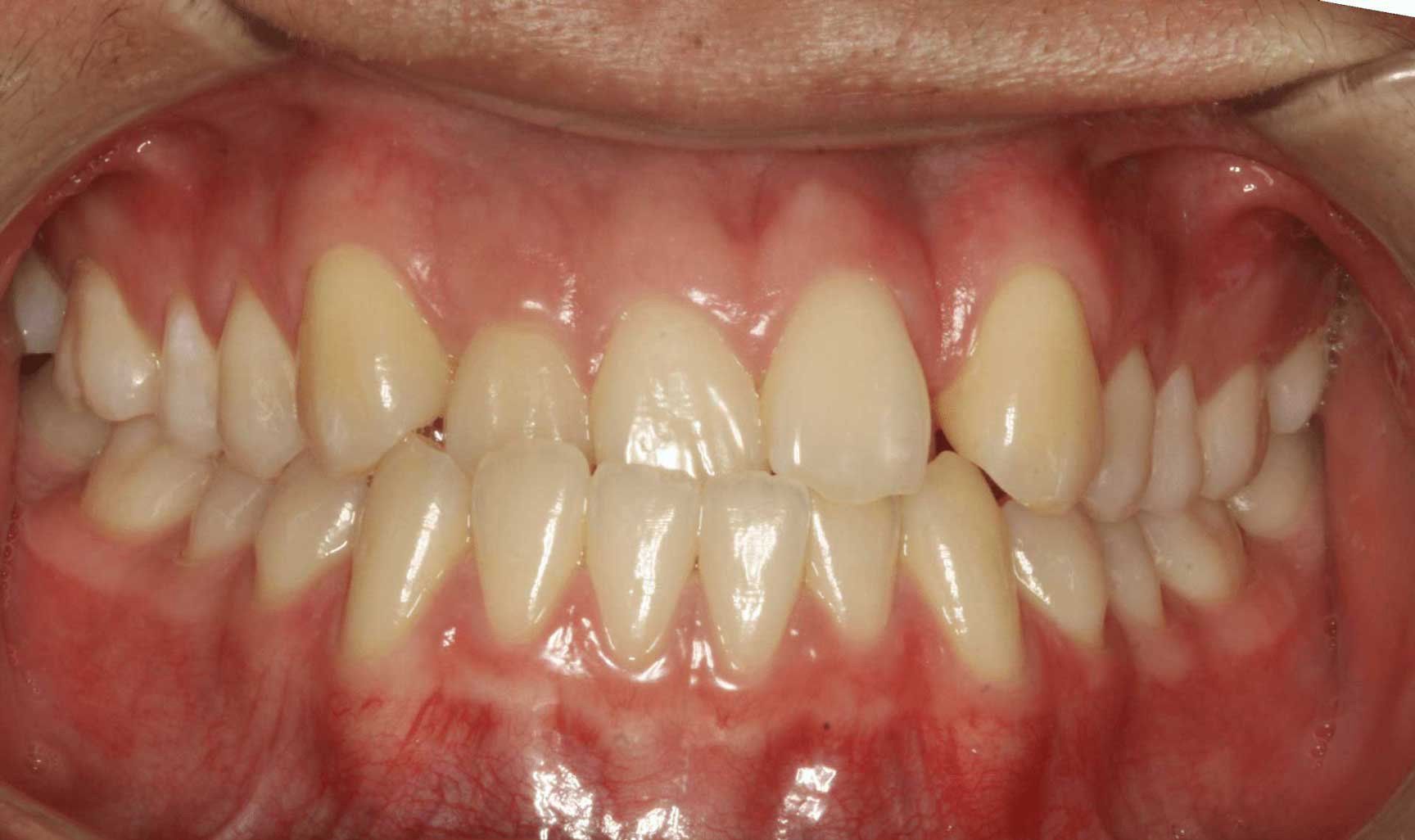 Patient Teeth Before Invisalign Treatment — Kansas City, MO — Koehn Dentistry & Aesthetics