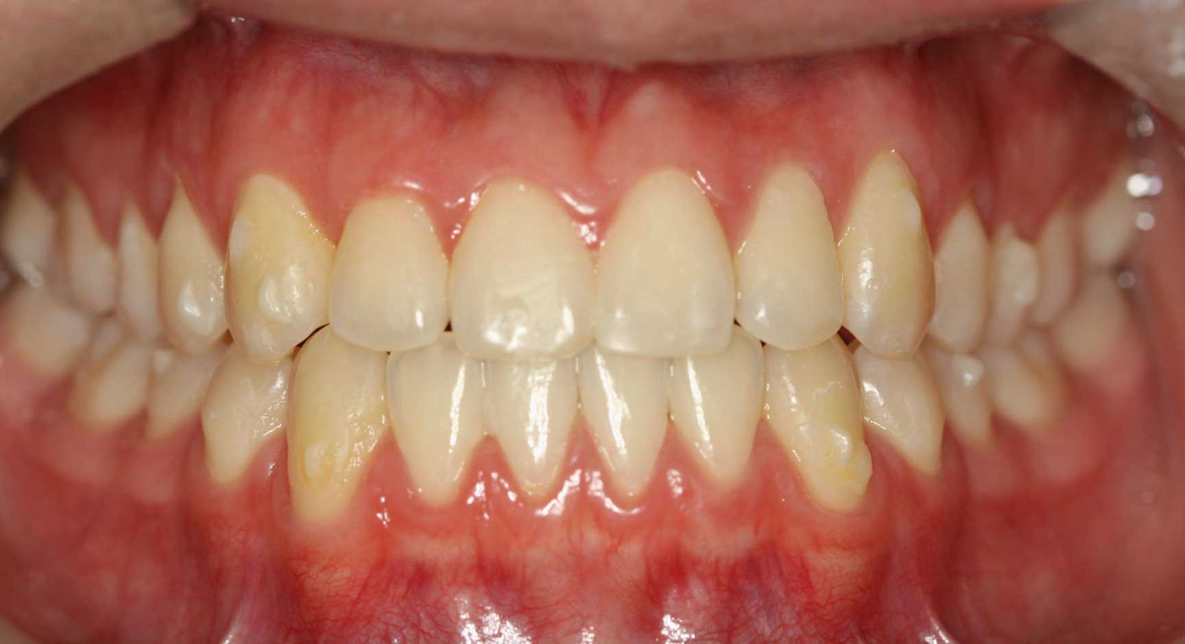 Patient Teeth Before Invisalign Treatment — Kansas City, MO — Koehn Dentistry & Aesthetics