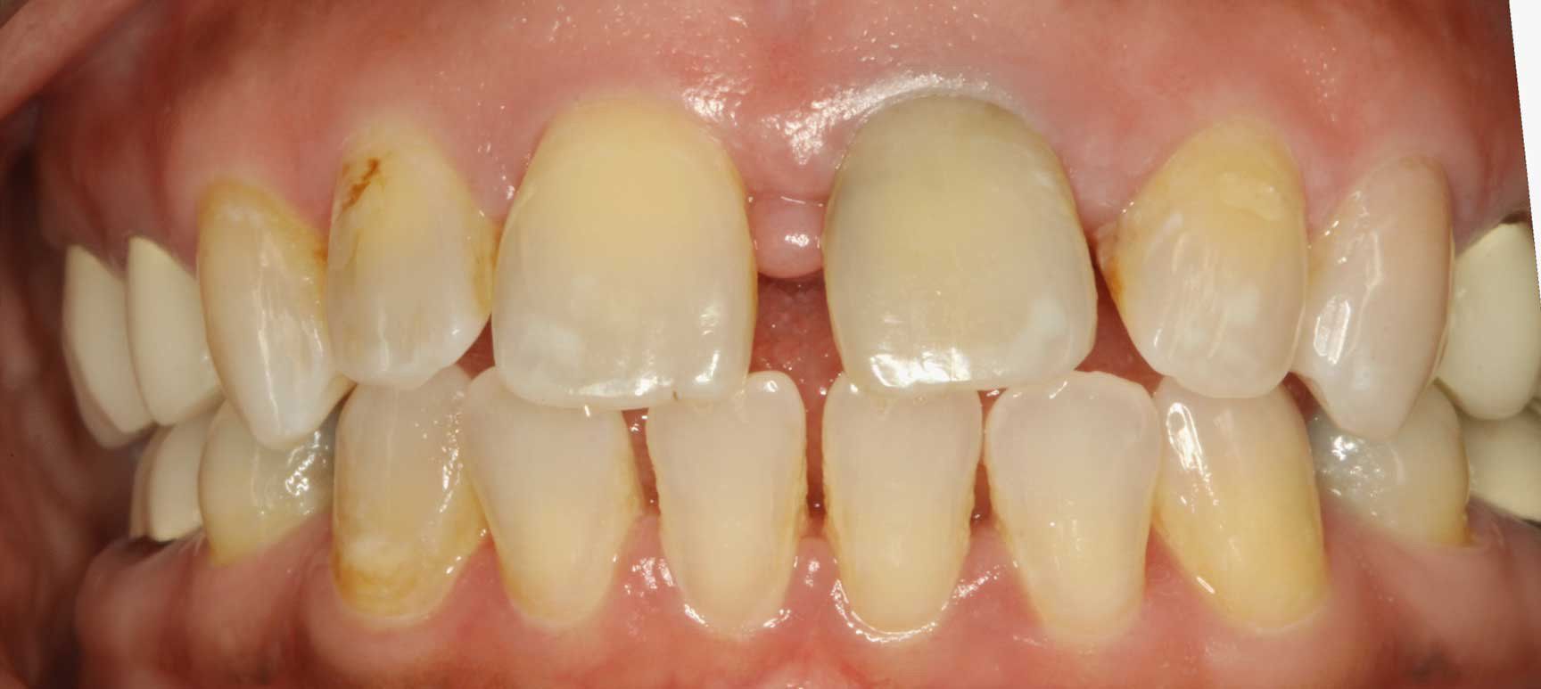 Before Invisalign Treatment — Kansas City, MO — Koehn Dentistry & Aesthetics