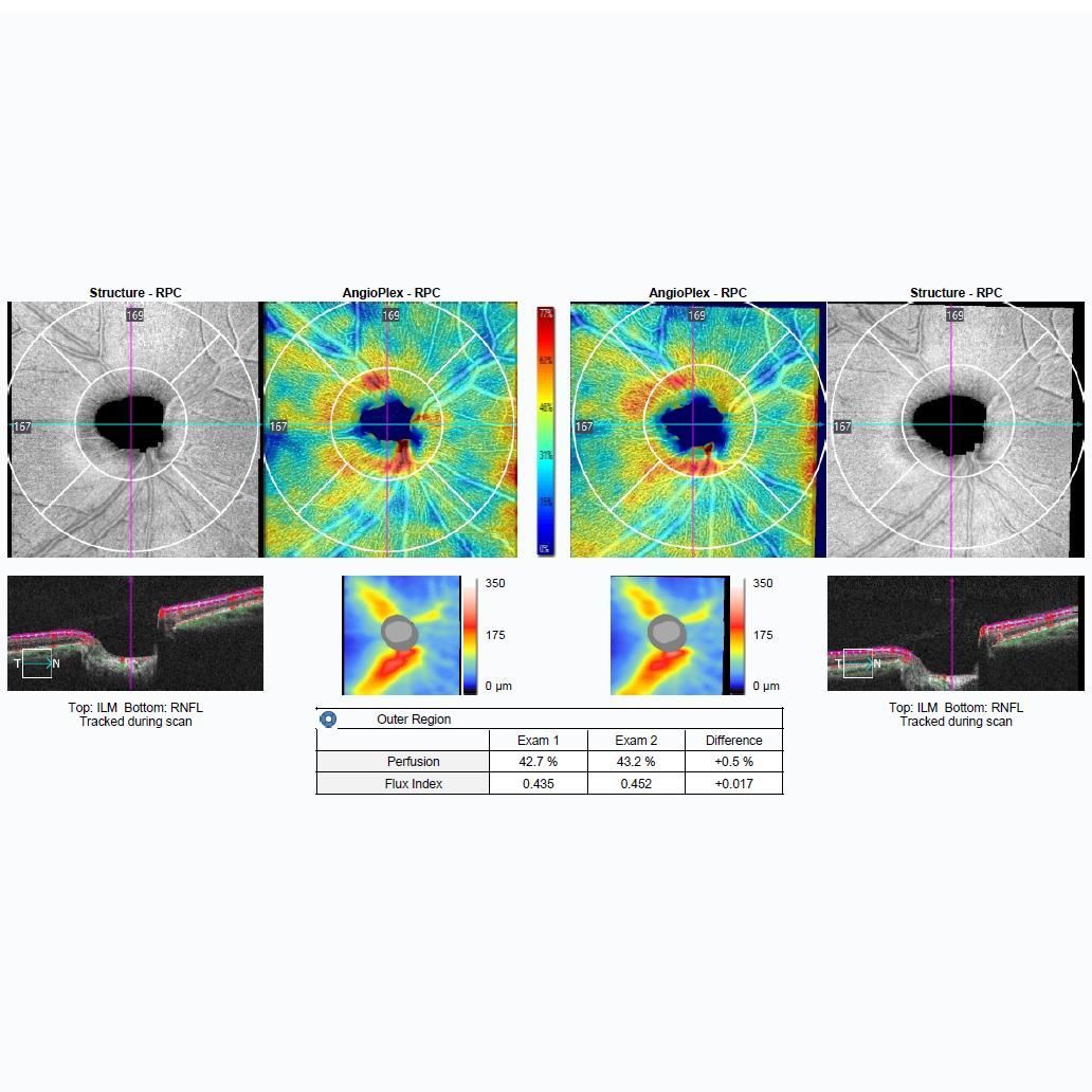 Optical Coherence Tomography (OCT) scan showing retinal thickness maps, optic nerve head cross-sections, and data tables.
