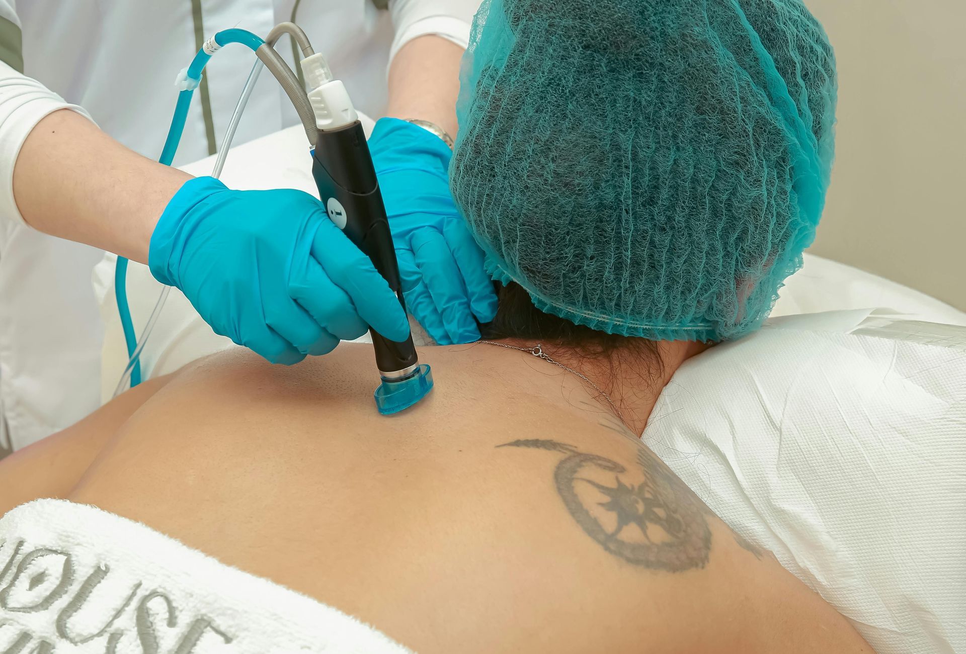A woman is getting a tattoo removed from her back.
