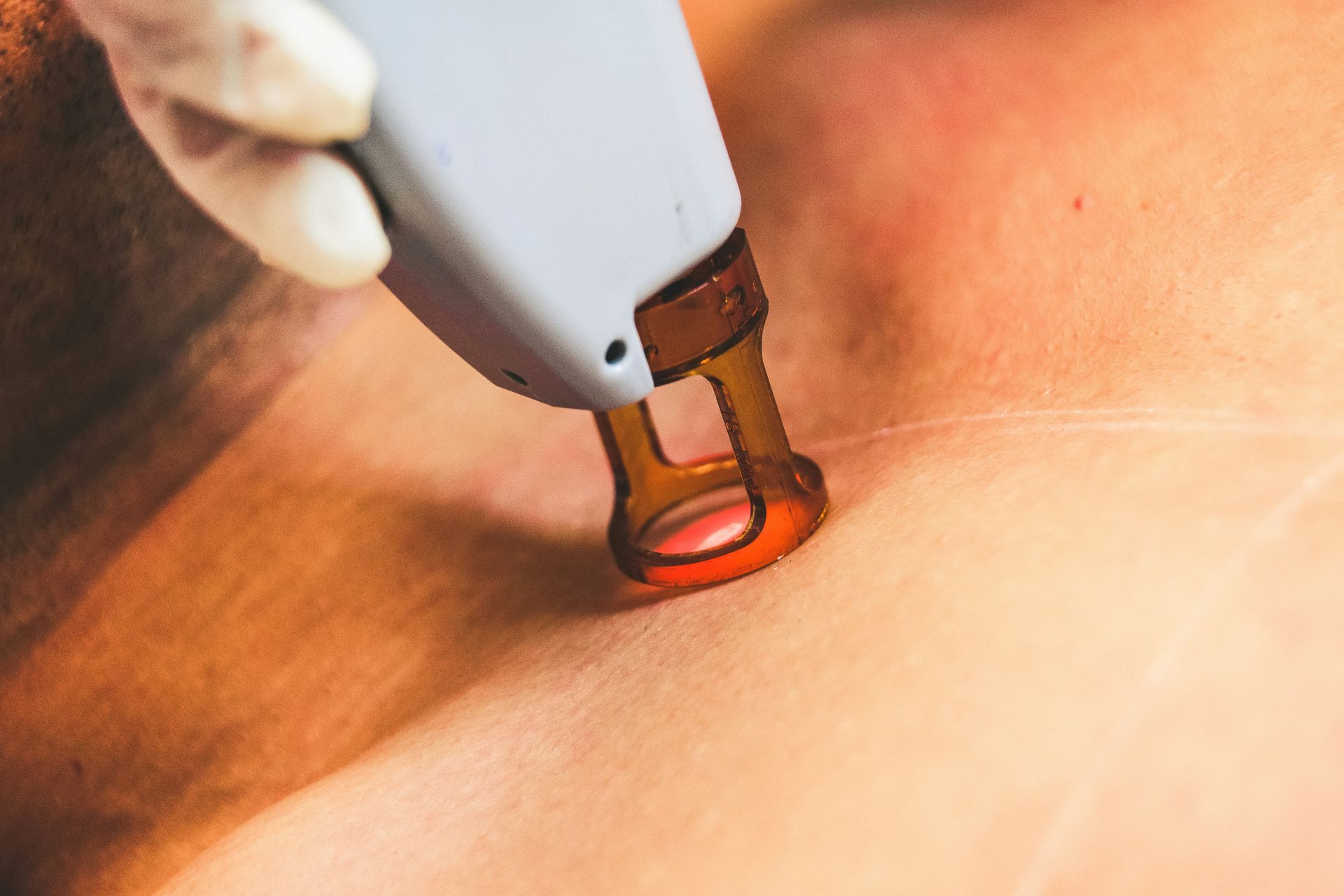 A person is getting a laser hair removal treatment on their back.