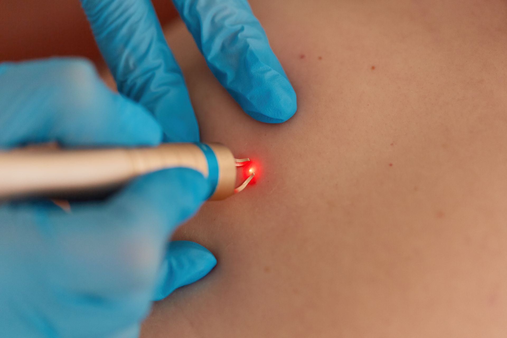 A person is getting a laser treatment on their back.