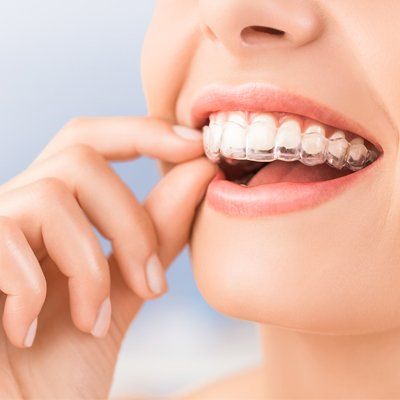 Woman wearing Invisalign aligner