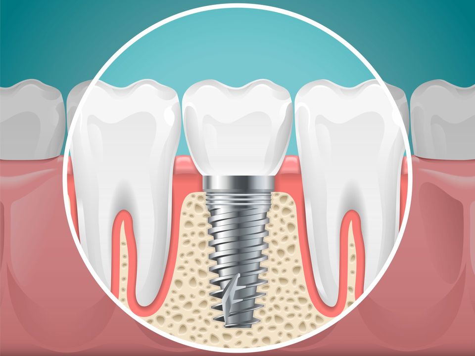Teeth — Female Patient Choosing Tooth Implant Looking At Mirror In Modern Dental Clinic in Bangor, ME