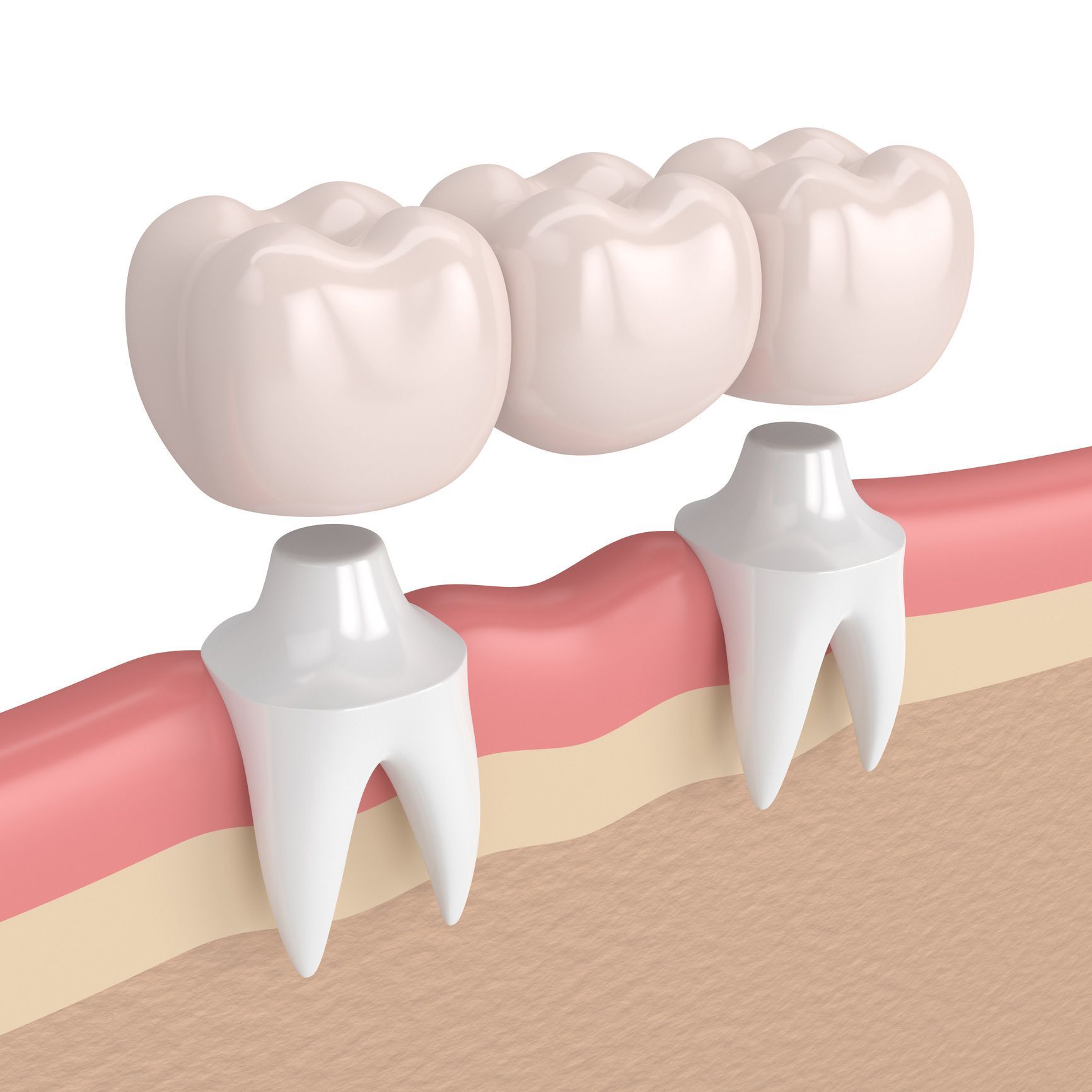 Dental crowns procedure in Orono ME by Stillwater Dental Associates showing a dental bridge placemen